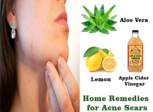 Acne Scars